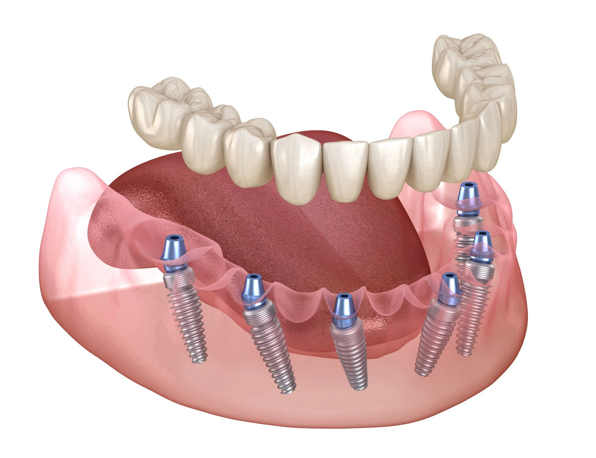 Immediate Implants