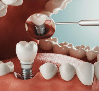 ICD Implantation