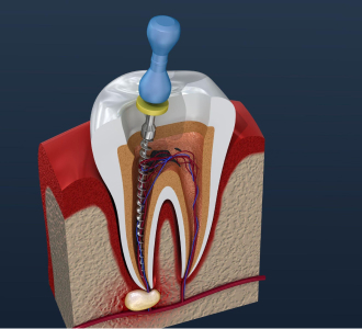 Pacemaker Implantation