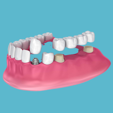 Implant Dentistry